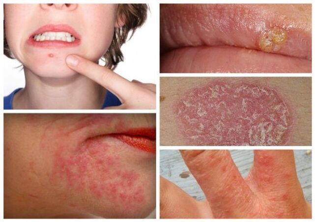 Az allergiák és a bőrbetegségek a paraziták jelei a szervezetben