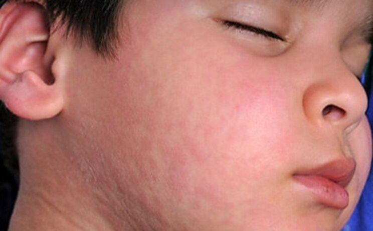 Allergiás kiütések a bőrön - a parazita férgek jelenlétének tünete a szervezetben