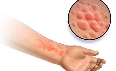 A schistosomosis megnyilvánulása az emberekben
